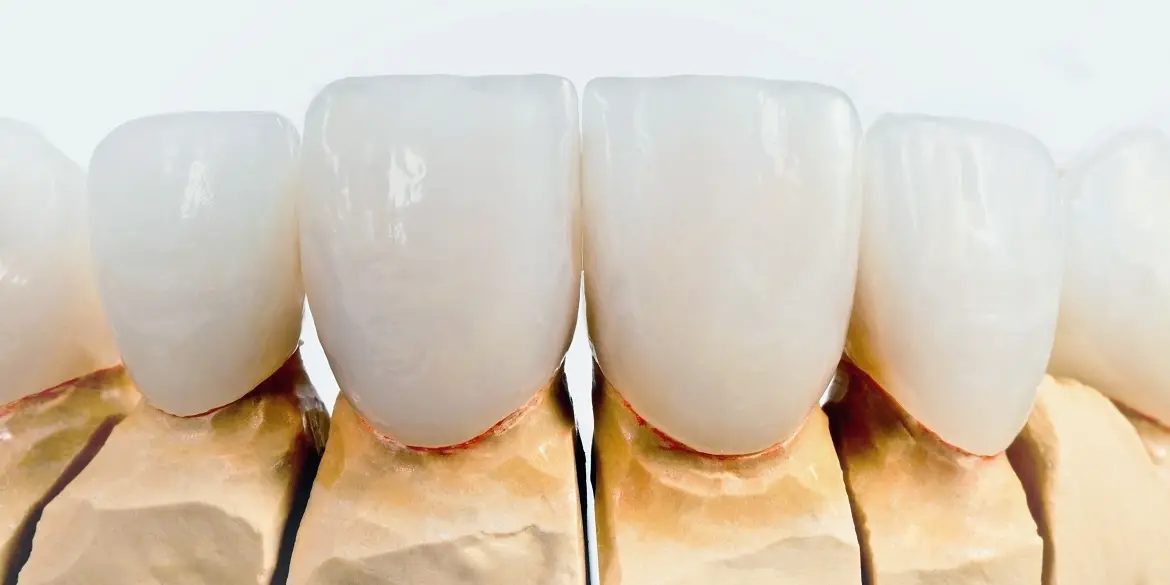 licówki zębowe
